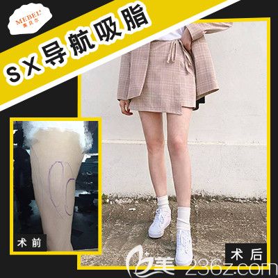 揚(yáng)州做大腿吸脂推薦美貝爾案例