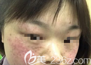 淄博激光祛斑術(shù)前照片 淄博激光祛斑術(shù)前照片
