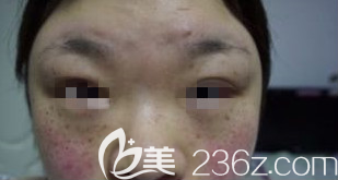 淄博激光祛斑術(shù)后第7天 淄博激光祛斑術(shù)后第7天