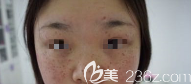 淄博激光祛斑術(shù)后第10天 淄博激光祛斑術(shù)后第10天