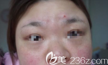 花不到兩千在淄博做了激光祛斑手術術后30天來分享照片+心得體會