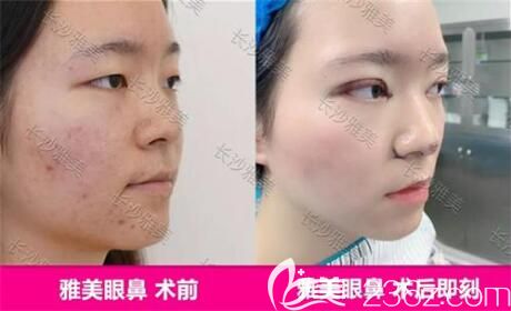 在雅美做眼鼻術(shù)前術(shù)后即刻效果對比照 在雅美做眼鼻術(shù)前術(shù)后即刻效果對比照