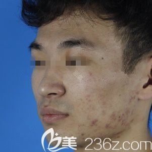 在石家莊天伊美做激光祛痘前滿臉痘痘 在石家莊天伊美做激光祛痘前滿臉痘痘