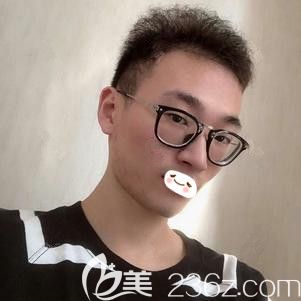 張斌醫(yī)生為我做紅藍光祛痘術后15天痘痘痘印消失 張斌醫(yī)生為我做紅藍光祛痘術后15天痘痘痘印消失