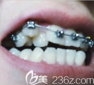 太原眾牙口腔正畸一個月時的牙齒照