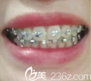 太原眾牙口腔正畸一年效果圖