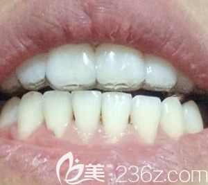 找太原眾牙口腔盧鵬做了牙齒正畸，今天來分享我戴金屬牙套矯正虎牙外凸的經(jīng)歷