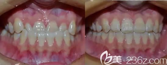 太原眾牙口腔牙齒矯正前后效果對比圖