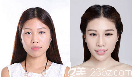 中信惠州醫(yī)院整形科陳虹醫(yī)生雙眼皮對(duì)比圖 中信惠州醫(yī)院整形科陳虹醫(yī)生雙眼皮對(duì)比圖