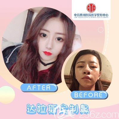 中信惠州醫(yī)院整形科陳虹醫(yī)生隆鼻對(duì)比圖 中信惠州醫(yī)院整形科陳虹醫(yī)生隆鼻對(duì)比圖