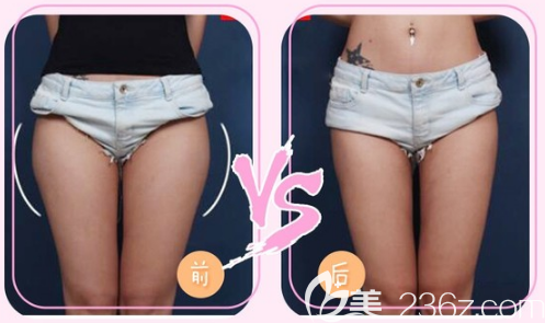 中信惠州醫(yī)院整形科陳虹醫(yī)生大腿吸脂對(duì)比圖 中信惠州醫(yī)院整形科陳虹醫(yī)生大腿吸脂對(duì)比圖