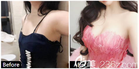 中信惠州醫(yī)院整形科陳虹醫(yī)生隆胸對(duì)比圖 中信惠州醫(yī)院整形科陳虹醫(yī)生隆胸對(duì)比圖