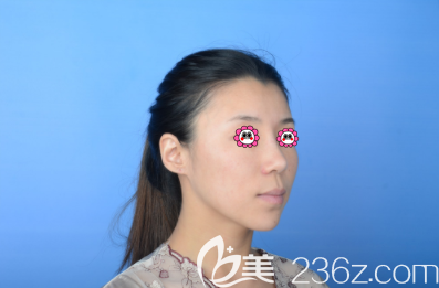 在北京藝美做下巴和淚溝及眉間異物取出修復(fù)前樣子 在北京藝美做下巴和淚溝及眉間異物取出修復(fù)前樣子