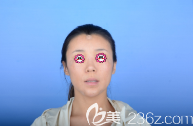 鞏敏醫(yī)生給我做下巴和淚溝及眉間異物取出修復(fù)頭一日樣子 鞏敏醫(yī)生給我做下巴和淚溝及眉間異物取出修復(fù)頭一日樣子