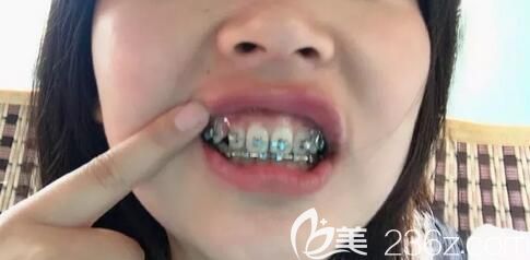 我在深圳弘和口腔做牙齒矯正剛戴牙套 我在深圳弘和口腔做牙齒矯正剛戴牙套