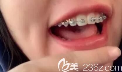 我在深圳弘和口腔做牙齒矯正第5個月 我在深圳弘和口腔做牙齒矯正第5個月