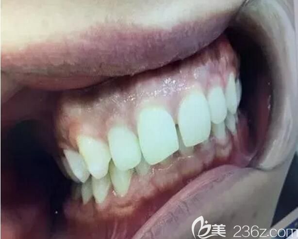 我在深圳弘和口腔做牙齒矯正前的照片 我在深圳弘和口腔做牙齒矯正前的照片