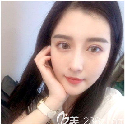在中信惠州醫(yī)院整形科做完雙眼皮一個(gè)月了