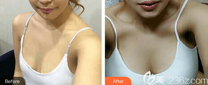 北京紫潔醫(yī)美王春燕自體脂肪豐胸前后對(duì)比效果圖