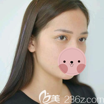 看看宜賓韓美詹清做的雙眼皮術(shù)后一個月恢復(fù)效果圖 我覺得自己現(xiàn)在美得不得了