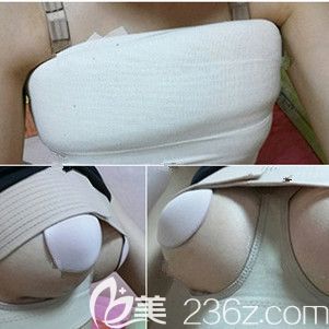 術(shù)后三天復(fù)查假體恢復(fù)情況