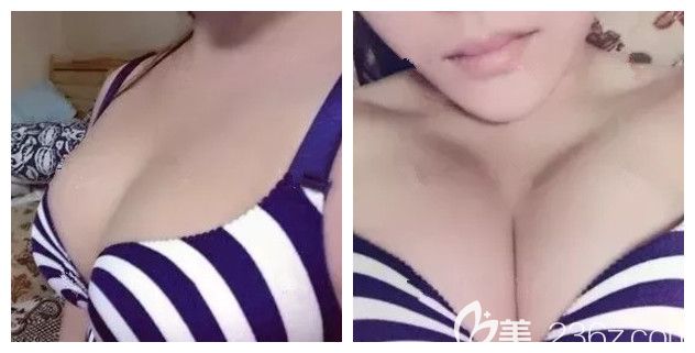 做了娜綺麗假體隆術(shù)后半個月恢復(fù)