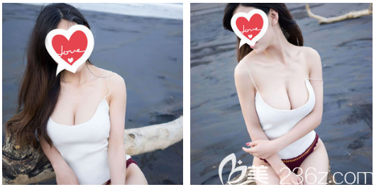 公開(kāi)我花兩萬(wàn)多元找中信惠州醫(yī)院整形美容科陳虹醫(yī)生做假體隆胸的親身經(jīng)歷