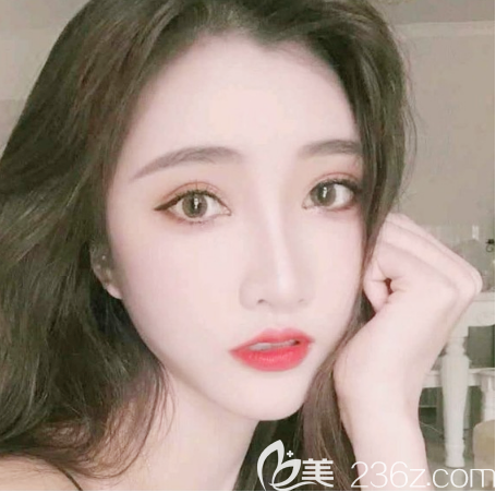 面部凹陷很顯老于是我去中信惠州醫(yī)院整形美容科找陳虹做了面部自體脂肪填充來(lái)改善