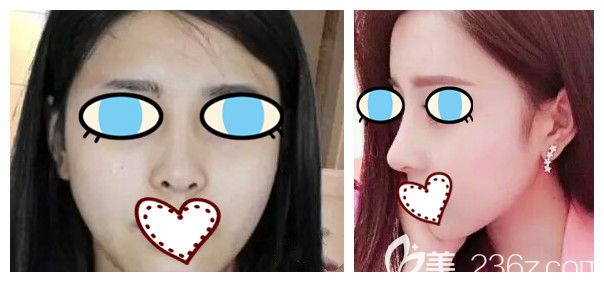 南寧華美胡凱自體肋軟骨隆鼻案例