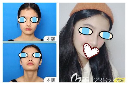  南寧華美整形胡凱鼻綜合隆鼻案例