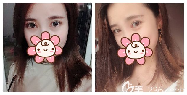 南京榜單前十中的美萊整形能做眼綜合不?小仙女已公開做韓式切開雙眼皮+開內(nèi)眼角+上瞼下垂矯正的恢復日記