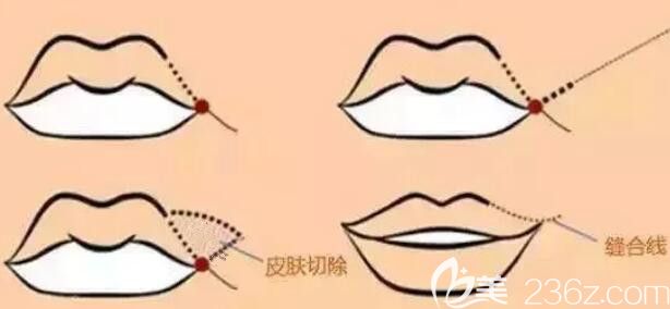 嘴角上揚術(shù)的過程 嘴角上揚術(shù)的過程