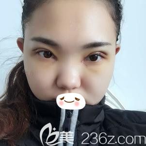 張柏松醫(yī)生為我做雙眼皮術(shù)后即刻效果
