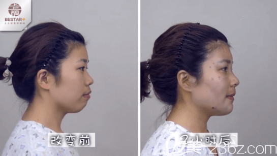 我在北京上上相改善凸嘴前和手術(shù)兩小時后對比效果