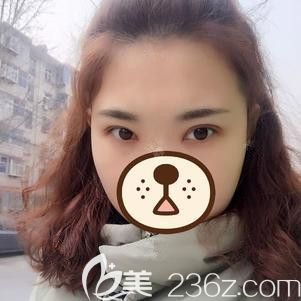 在石家莊天伊美做雙眼皮術(shù)后一周進(jìn)行拆線