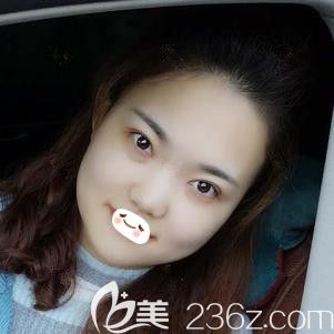 張柏松醫(yī)生為我做切開雙眼皮16天完全消腫