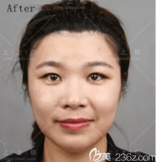 我在北京上上相做ART自體脂肪骨性移植技術(shù)改善凸嘴恢復(fù)中效果