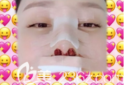 漢中假體隆鼻術(shù)后即刻的樣子
