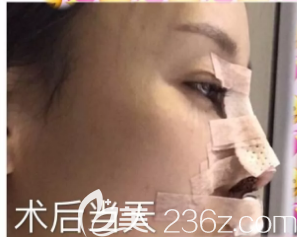 漢中假體隆鼻術(shù)后第2天