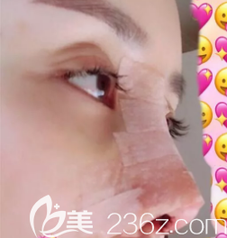 漢中假體隆鼻術(shù)后第3天