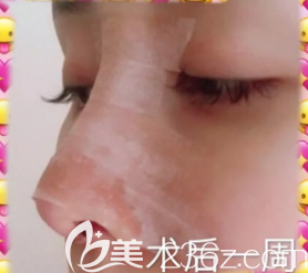 漢中假體隆鼻術(shù)后第6天