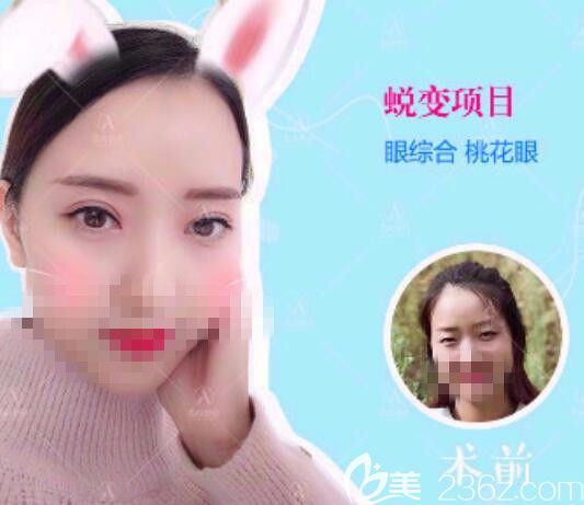 愛尚雙眼皮前后對比