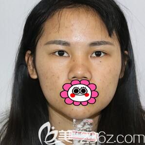 做自體軟骨隆鼻術(shù)前照片 做自體軟骨隆鼻術(shù)前照片