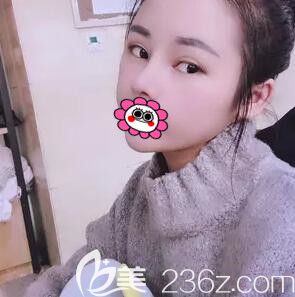 做半肋軟骨隆鼻半個(gè)月時(shí)的恢復(fù)效果圖 做半肋軟骨隆鼻半個(gè)月時(shí)的恢復(fù)效果圖