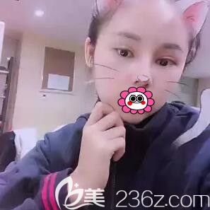 在亞韓做完半肋軟骨隆鼻30天時(shí)的恢復(fù)效果照 在亞韓做完半肋軟骨隆鼻30天時(shí)的恢復(fù)效果照