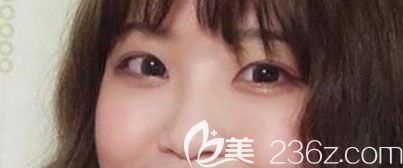 激光祛眼袋后悔死了，找韓國奧納比整形醫(yī)院張哲豪做眼底眶隔脂肪釋放術(shù)后竟然擁有臥蠶