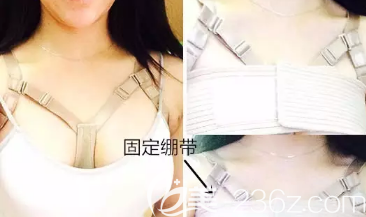 榆林假體隆胸術(shù)后7天的樣子