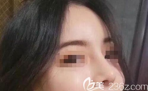 三個月前找曲靖靖美張金明做假體隆鼻+耳軟骨墊鼻尖,很穩(wěn)定,沒有出現(xiàn)過增生和紅腫