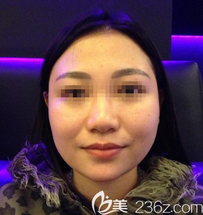 在韓國small face整形醫(yī)院做顴骨縮小+下頜角+脂肪填充術前 在韓國small face整形醫(yī)院做顴骨縮小+下頜角+脂肪填充術前