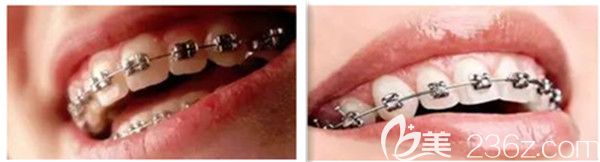 自鎖托槽和普通托槽的區(qū)別 自鎖托槽和普通托槽的區(qū)別